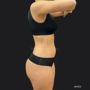 lipoaspiração