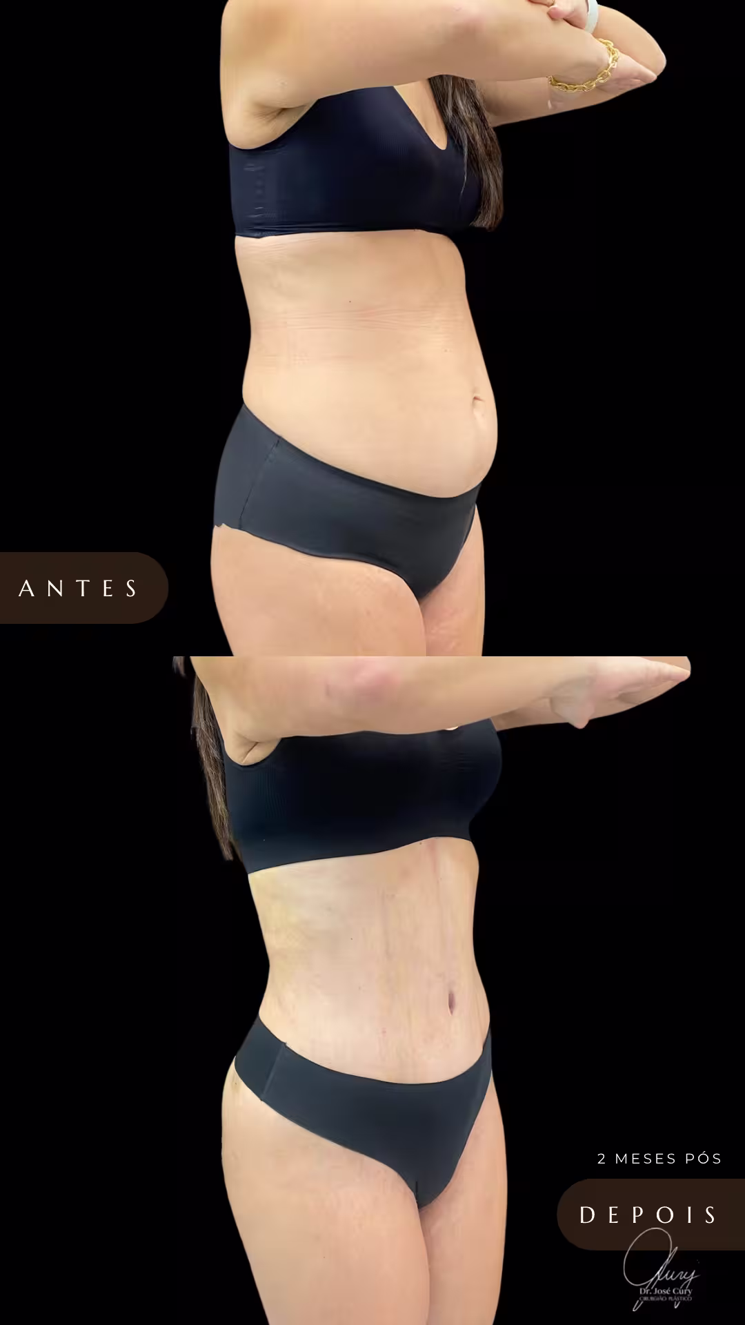 lipoabdominoplastia