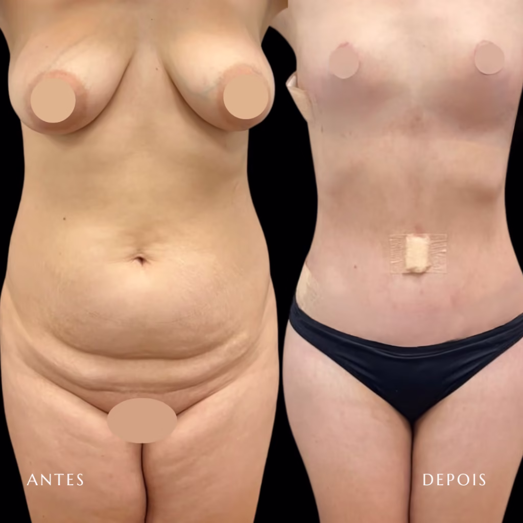 lipoabdominoplastia
