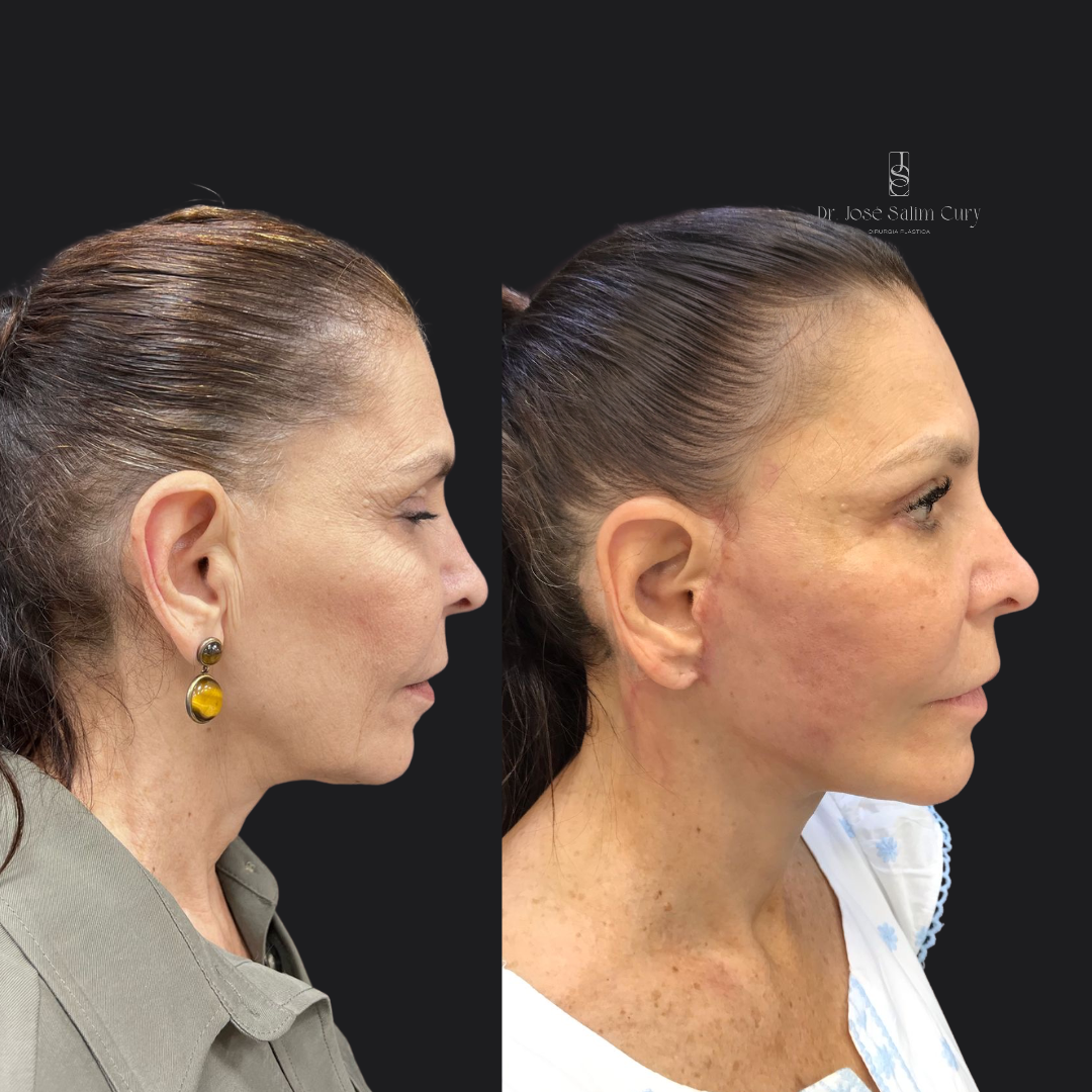 Facelift - Lifting facial