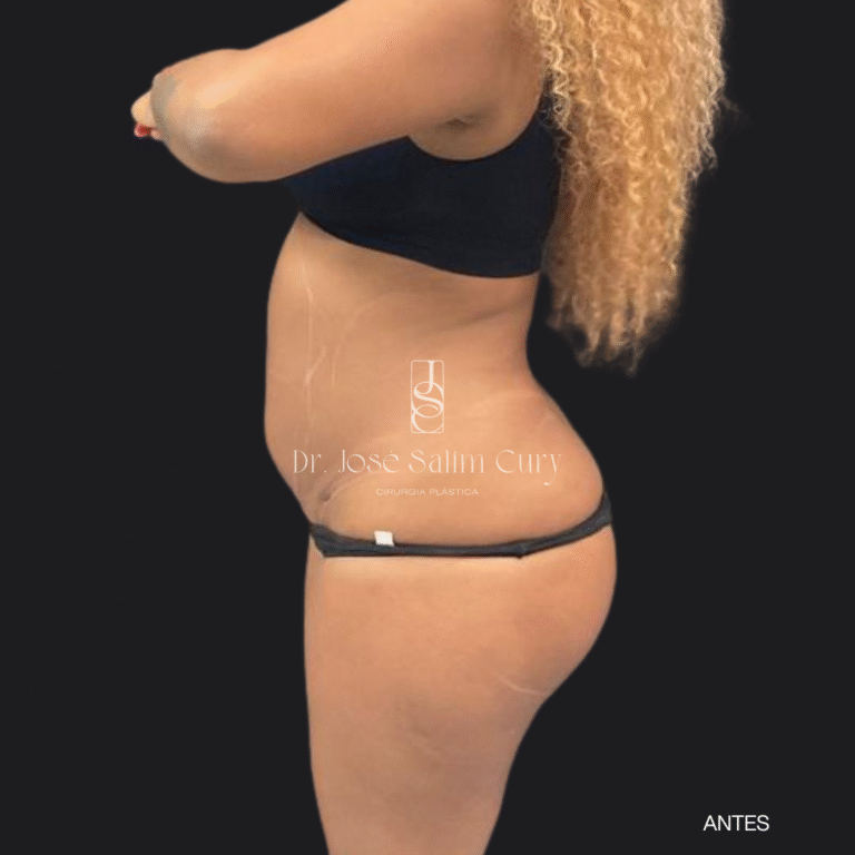 LIPOESCULTURA - 1 ANTES