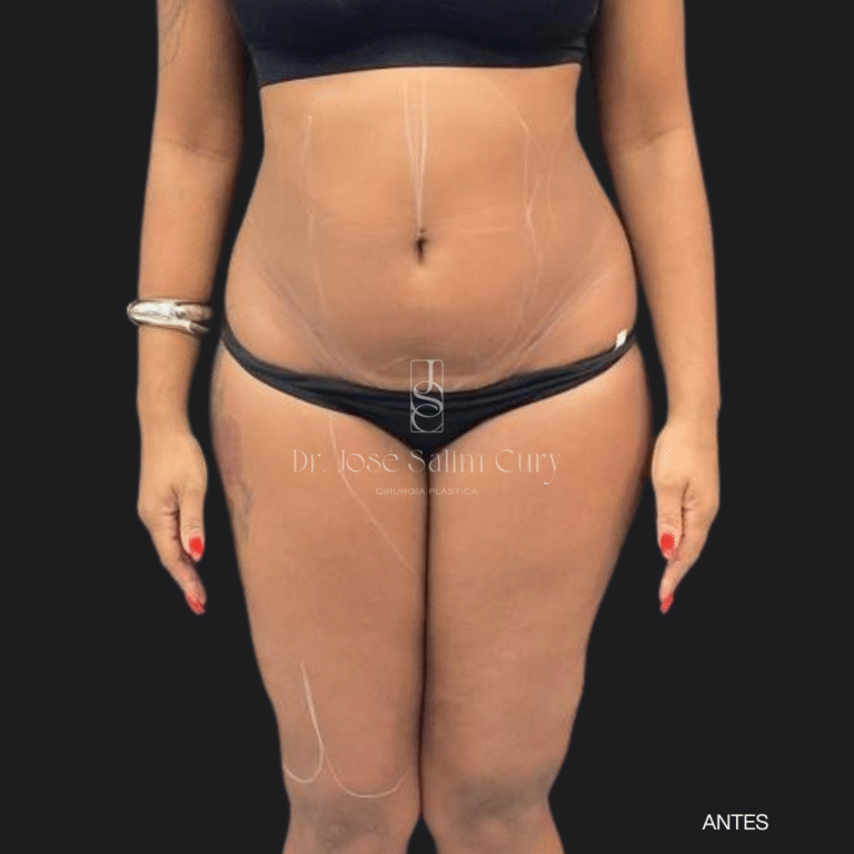 LIPOESCULTURA - ANTES