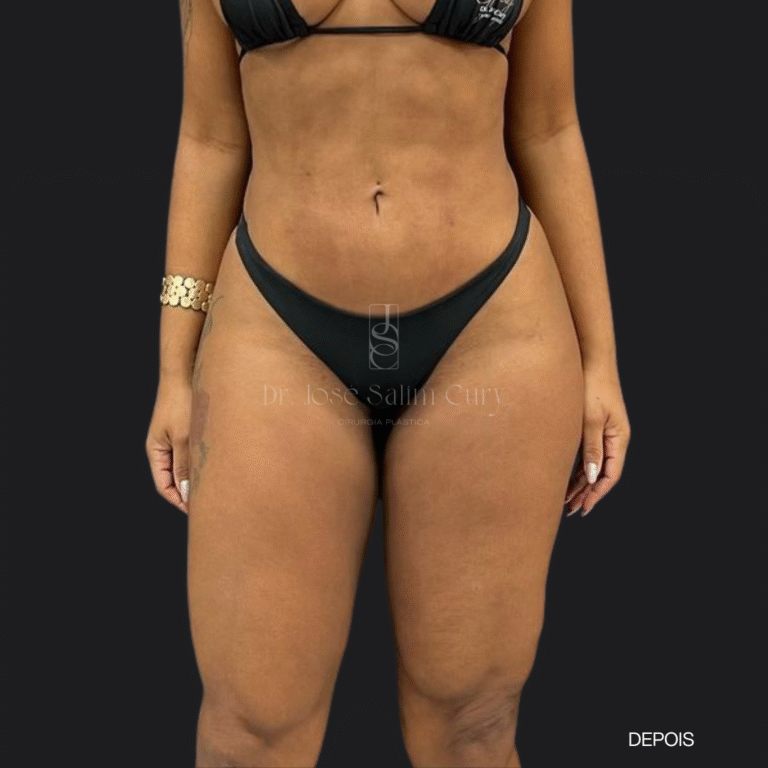 LIPOESCULTURA- DEPOIS