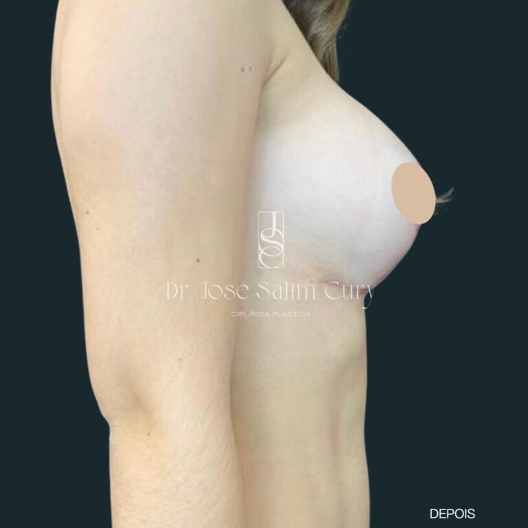 Mamoplastia de aumento - 2