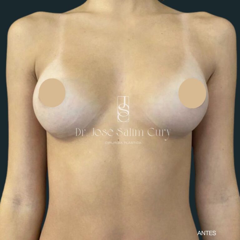 Mamoplastia de aumento - 3