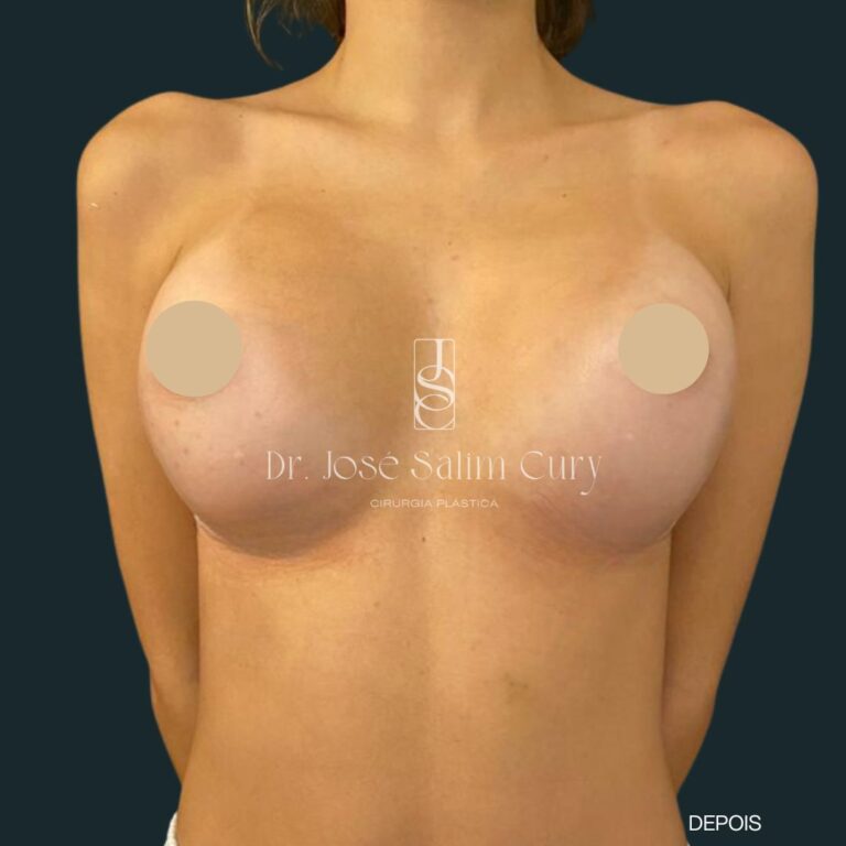 Mamoplastia de aumento - 4