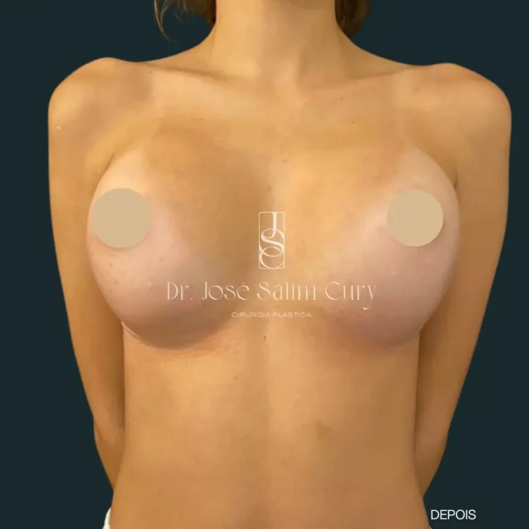 Mamoplastia-de-aumento-4
