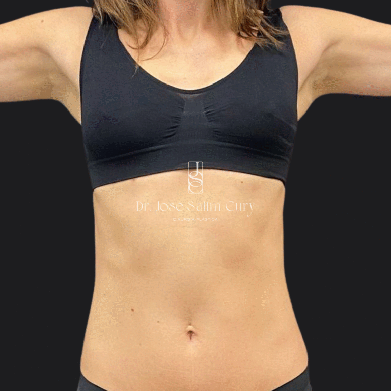 Mastopexia sem proteses - ANTES 1 (1)