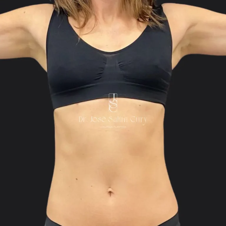 Mastopexia-sem-proteses-ANTES-1-1