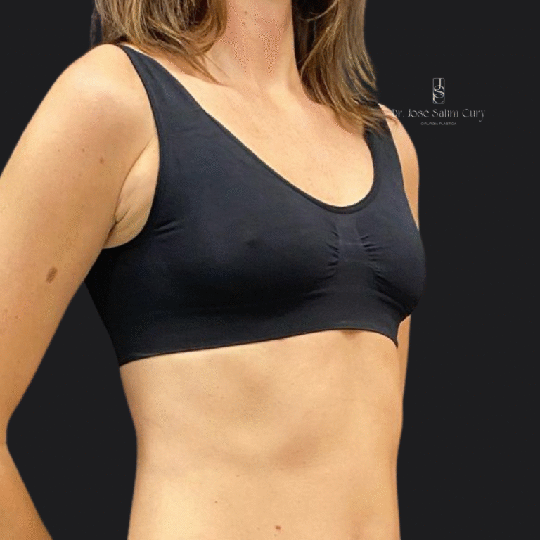 Mastopexia sem proteses - ANTES 2