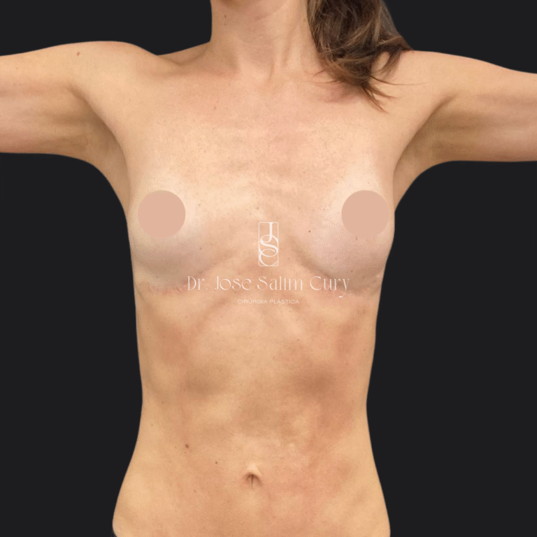 Mastopexia sem proteses - DEPOIS 1