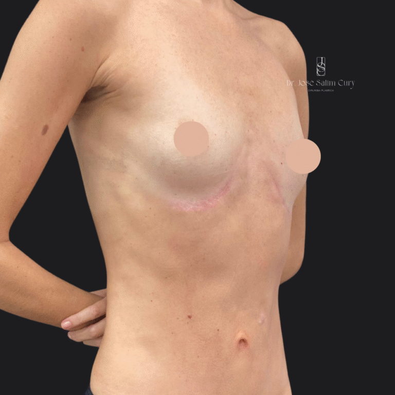 Mastopexia sem proteses - DEPOIS 2
