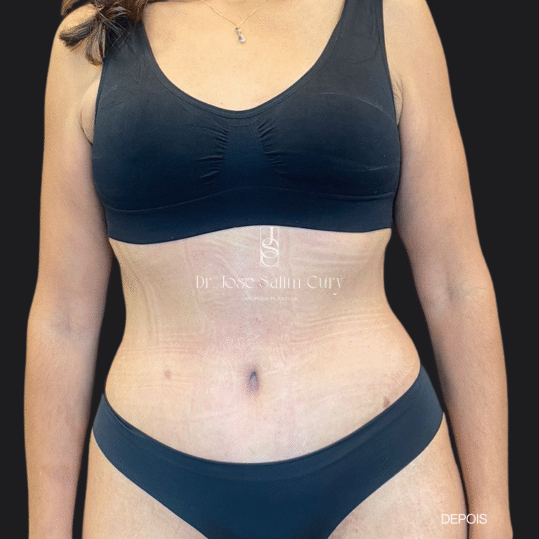 lipoabdome- 1 DEPOIS