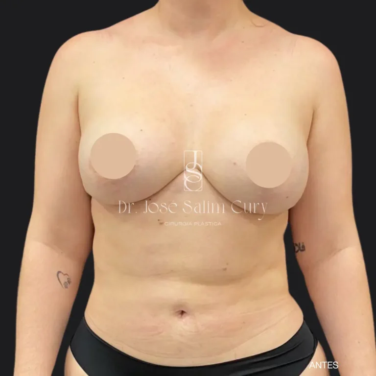 lipoabdome-2-ANTES