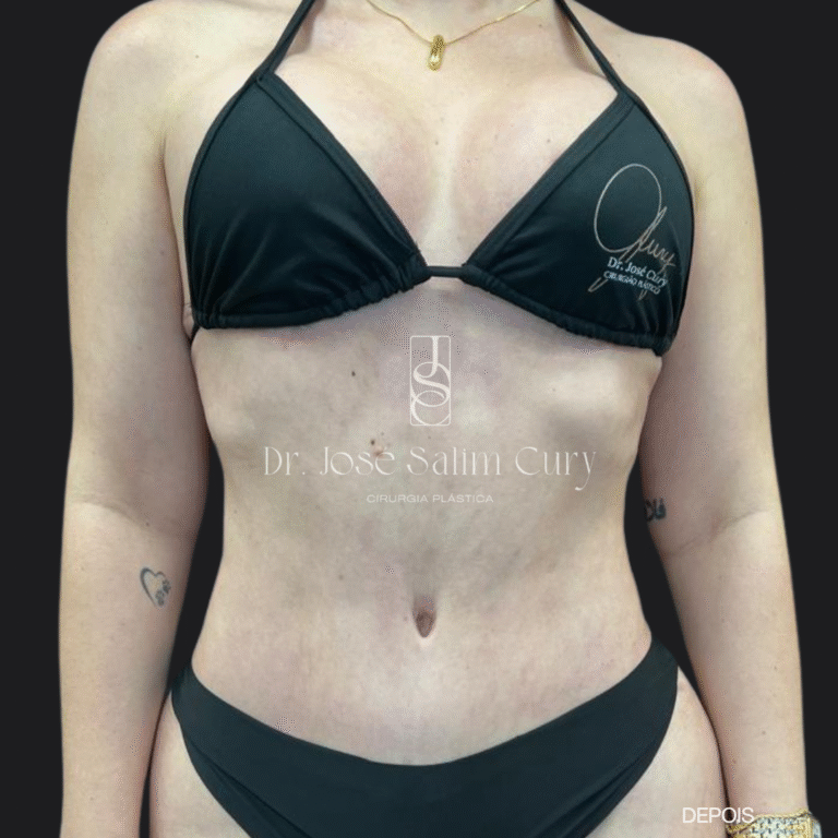 lipoabdome- 2 DEPOIS