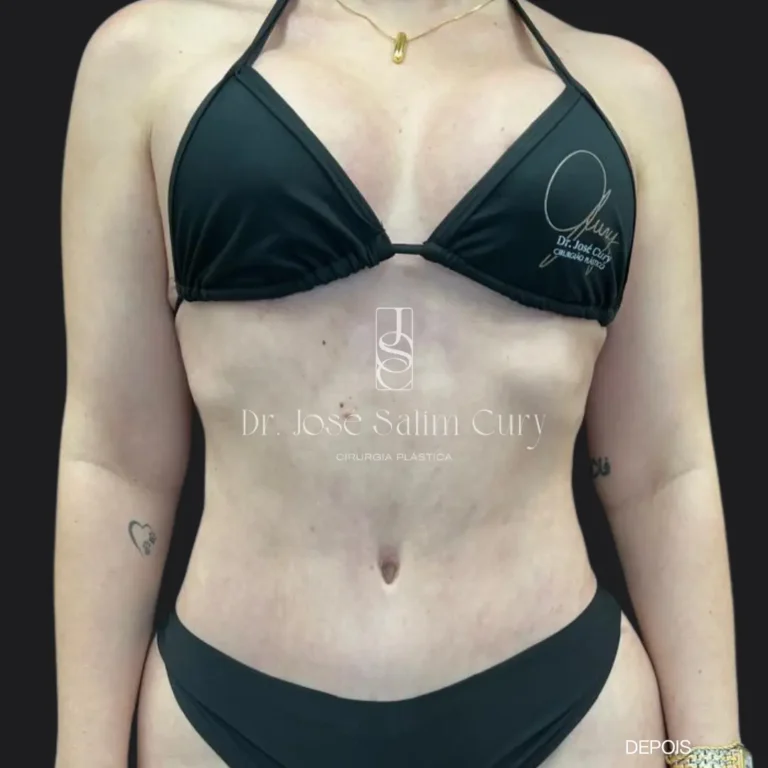 lipoabdome-2-DEPOIS
