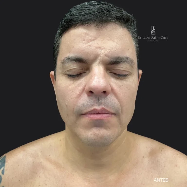 Blefo-ANTES1