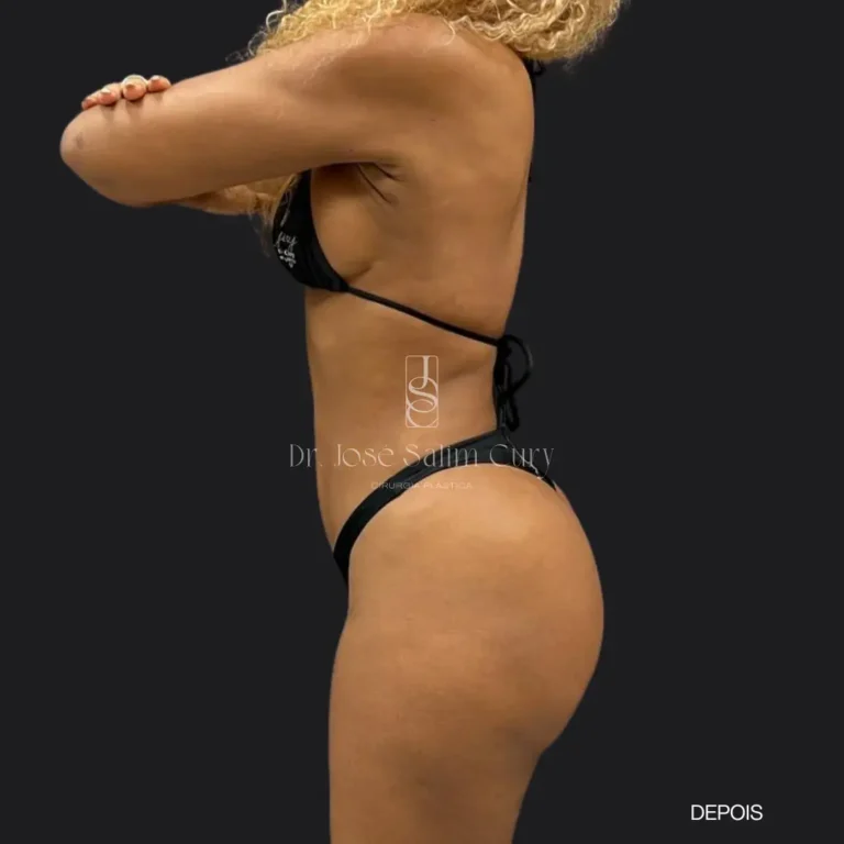 LIPOESCULTURA-2-DEPOIS