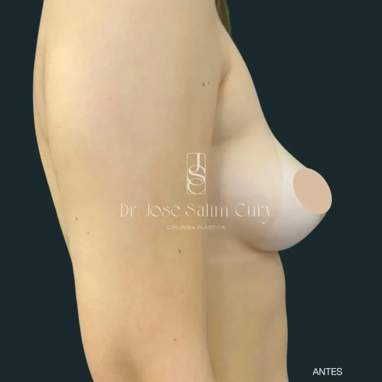 Mamoplastia-de-aumento-1