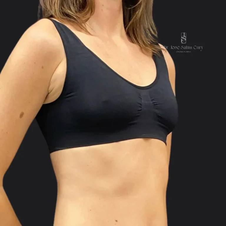 Mastopexia-sem-proteses-ANTES-2