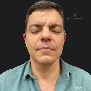 Blepharoplasty