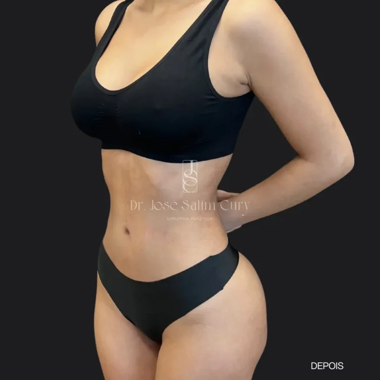 lipo-antes-2