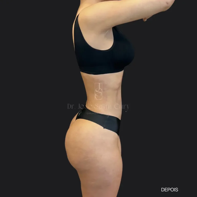 lipo-antes1