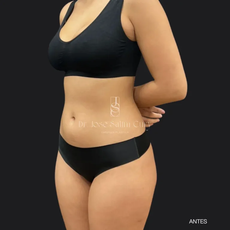 Liposuction