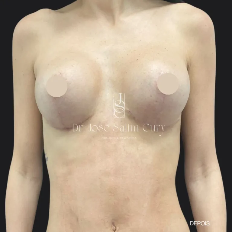 masto-com-protese