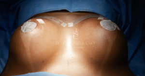 Body Contouring Surgery: Who Is It Indicated For? 1 Body Contouring Surgery