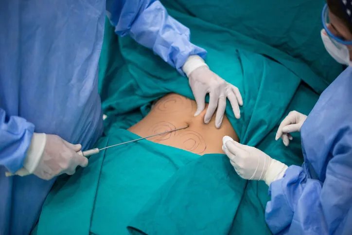 High Definition Liposuction 2 Lipo lad antes depois