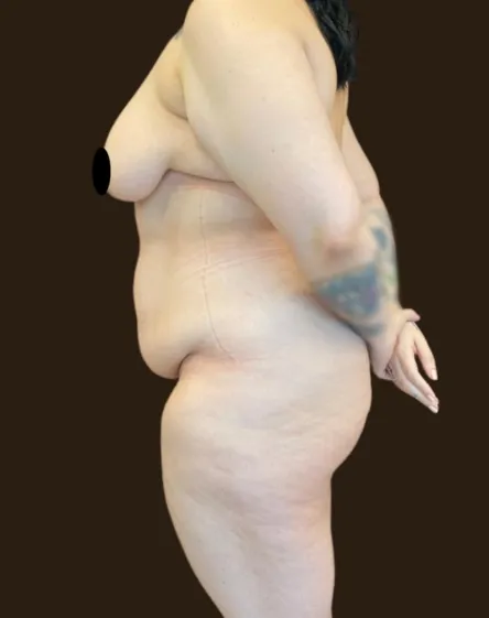 Lipoabdominoplastia 8 before image